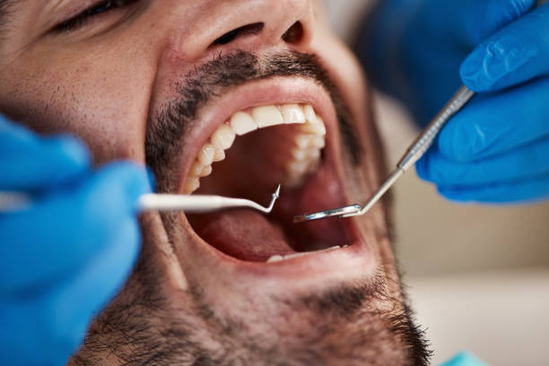 Best Emergency Root Canal Treatment in Macon, MS